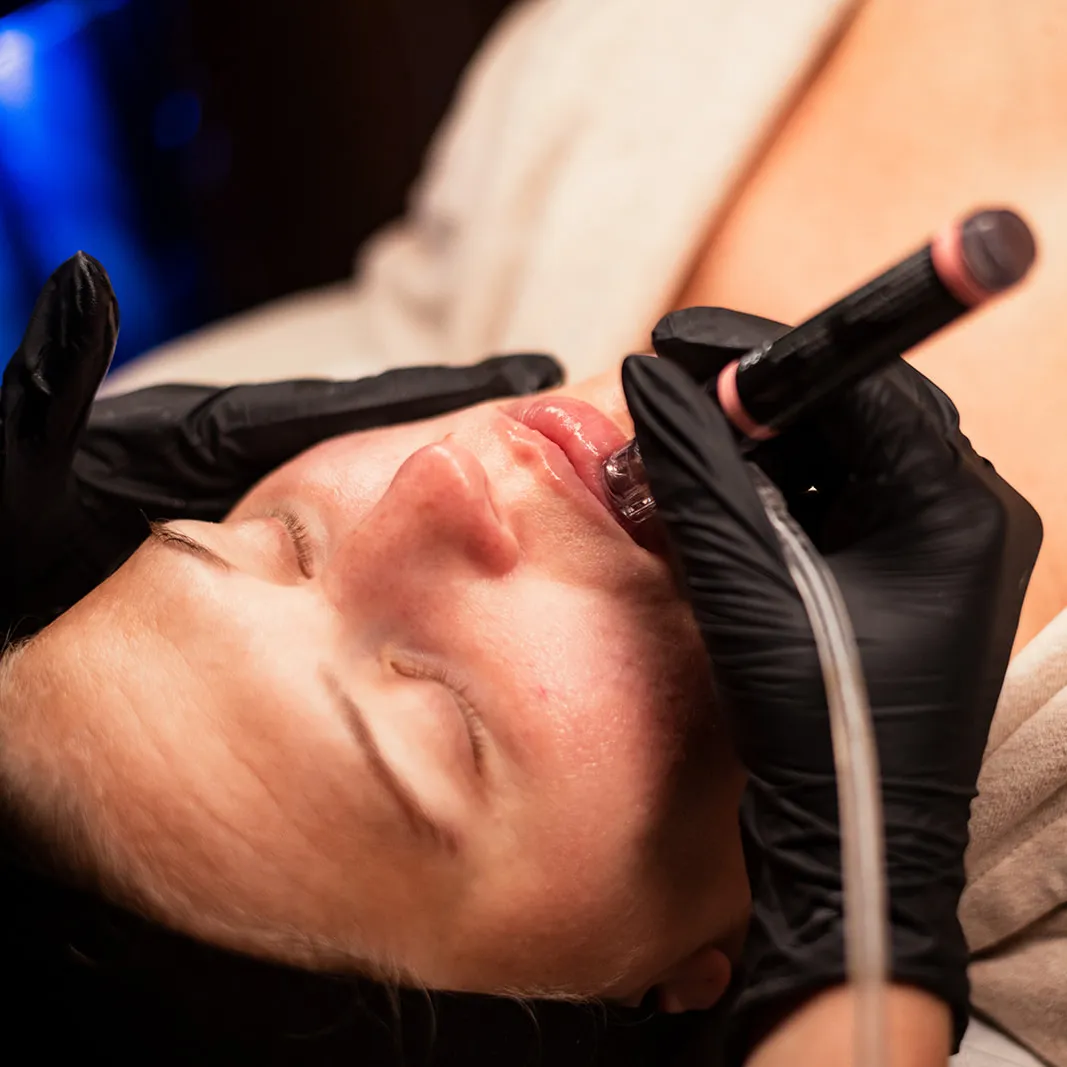 Hydrafacial Treatment Hydrafacial Treatment